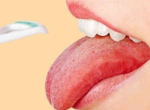 Hướng dẫn cách cầm máu khi bị chảy máu lưỡi nhanh chóng